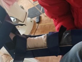 В Белоозерске нога ребенка застряла в батарее отопления