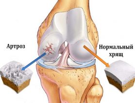 Артроз – болезнь изношенных суставов